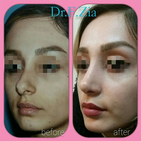 دکتر فیروزه ضیا - جراحی بینی رشت - جراح بینی رشت