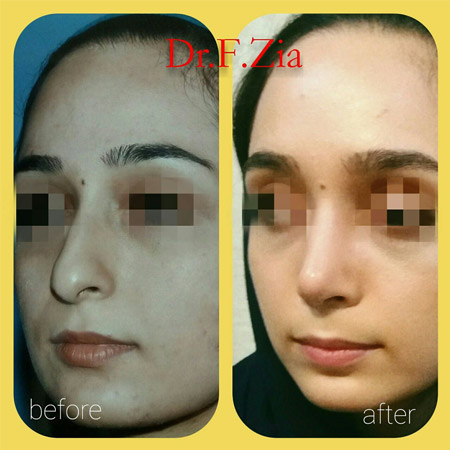 دکتر فیروزه ضیا - جراحی بینی رشت - جراح بینی رشت