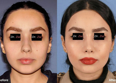 دکتر فیروزه ضیا - جراحی بینی رشت - جراح بینی رشت