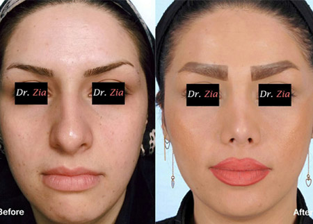 دکتر فیروزه ضیا - جراحی بینی رشت - جراح بینی رشت