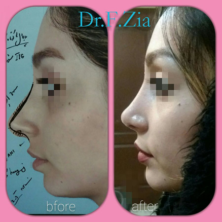 دکتر فیروزه ضیا - جراحی بینی رشت - جراح بینی رشت