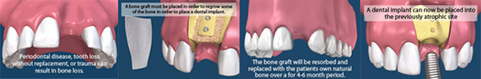 جراحی بازسازی استخوان جهت قراردادن ایمپلنت