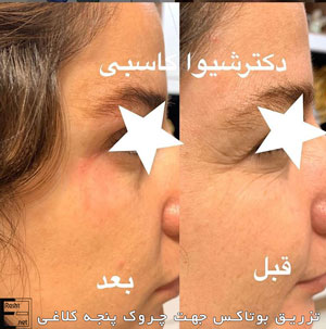 دکتر شیوا کاسبی - تزریق بوتاکس جهت رفع چین و چروک پنجه کلاغی